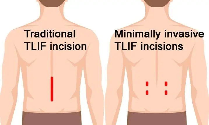 benefits of TLIF surgery in Mumbai