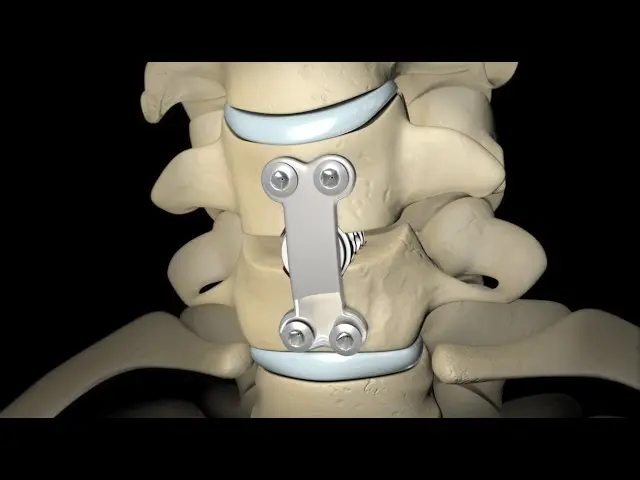 spinal fusion surgery in Mumbai