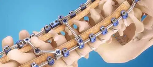 spinal reconstruction surgery in Mumbai