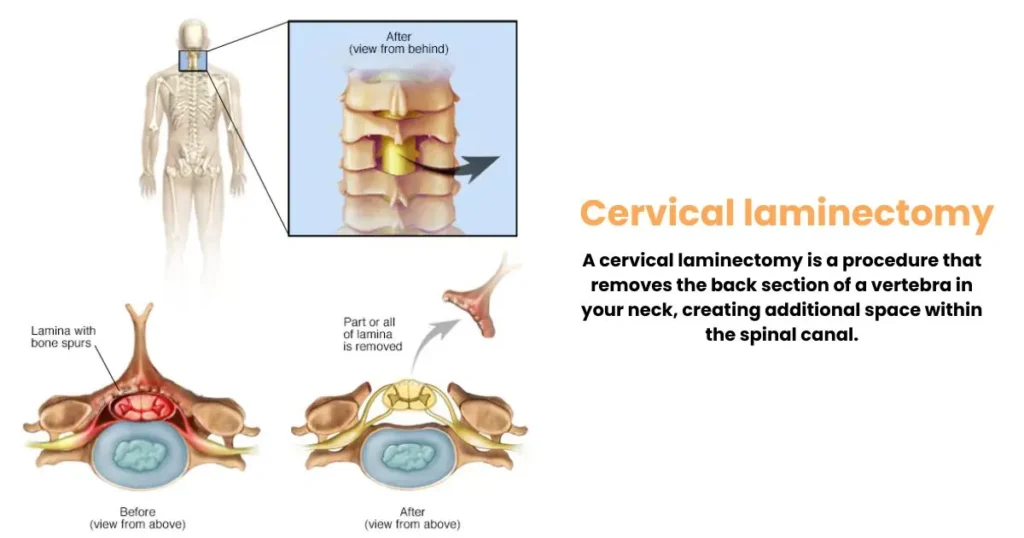 Cervical laminectomy