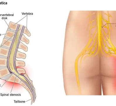 Sciatica Causes, Symptoms, Diagnosis, Treatment & Management_