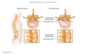 Slip Disk (Herniated Disk) - Causes and Symptoms