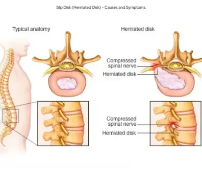 Slip Disk (Herniated Disk) - Causes and Symptoms