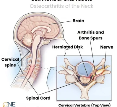 Spondylosis (Cervical) – Symptoms, Causes and Treatment_