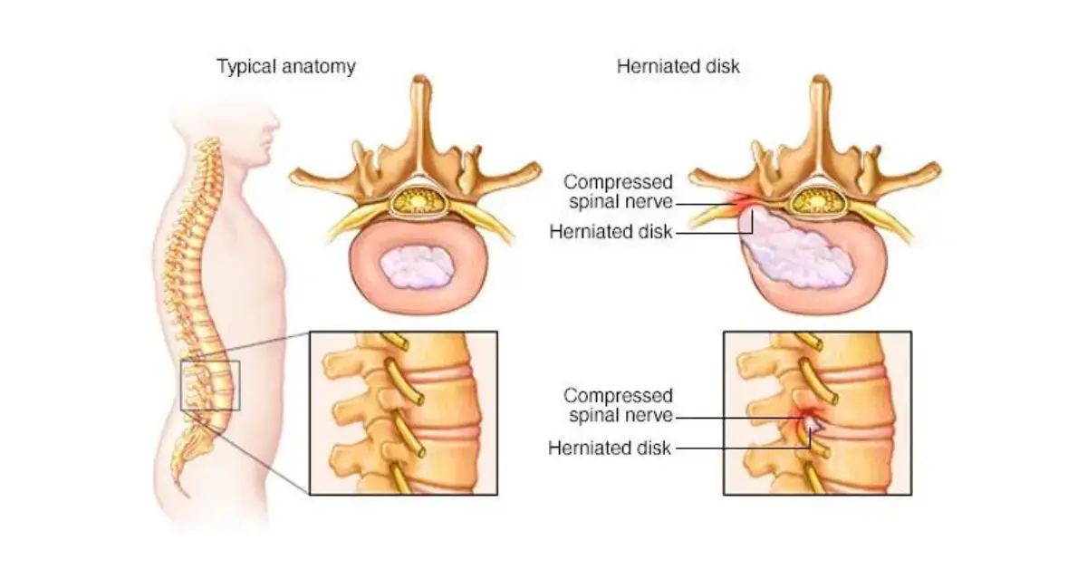 What Causes Sciatica