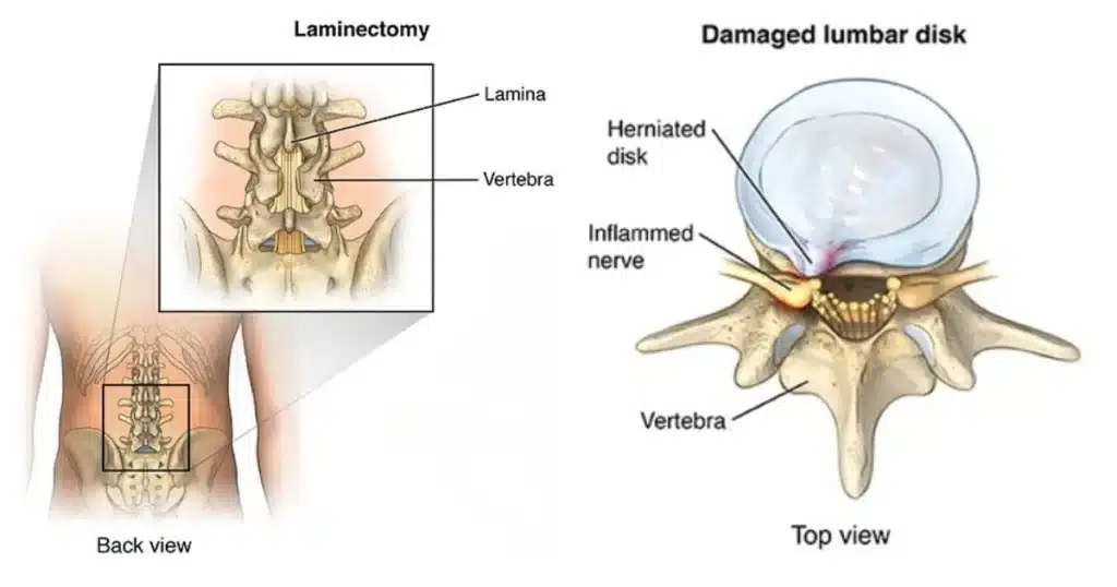 laminectomy - Surgery & Treatment, Procedure, Operation_