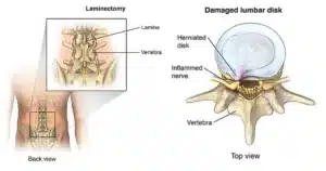 laminectomy - Surgery & Treatment, Procedure, Operation_