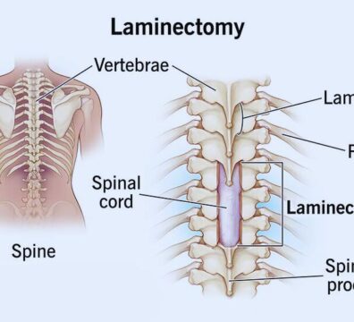 laminectomy operation