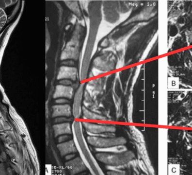 Cervical Disc Herniation MRI