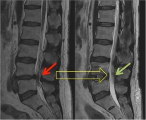 Blog 9 What Is Spinal Decompression Surgery