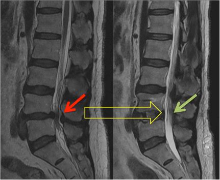 What Is Spinal Decompression Surgery
