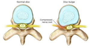 Blog 8 Slipped disc