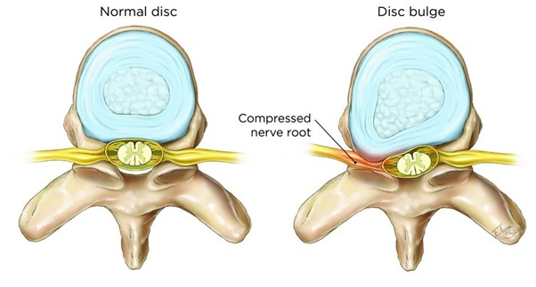 Slipped disc