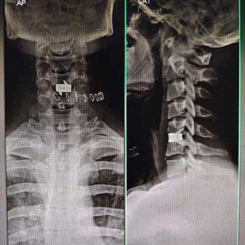 anterior cervical discectomy and fusion surgery